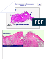 Carcinoma Epidermóide Da Pele - UNICAMP