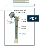 Fragmentation of The Cement Fracture of The Cement Mantle