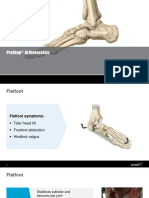 Prostop Arthroereisis