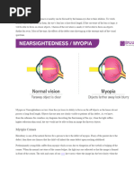 Myopia Causes