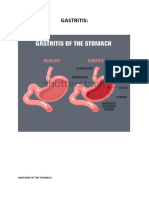 GASTRITIS