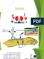 Fistula