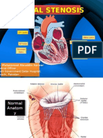 Mitral Stenosis