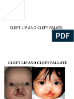 Cleft Palate and Lip