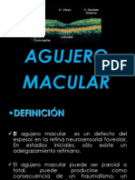 Agujero Macular