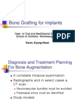 Bone Grafting For Implants