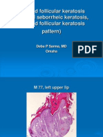 Inverted Follicular Keratosi (Irritated Seborrheic Keratosis), M 77 Left Upper Lip