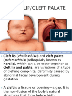 Cleft Lip Palate