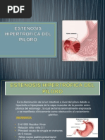 Estenosis Hipertrofica Del Piloro