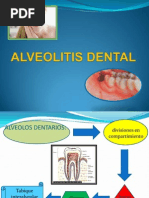 Alveolitis Dental Exposicion