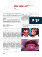 Prosthetic Rehabilitation of A Child Suffering From Hypohidrotic Ectodermal Dysplasia With Complete Anodontia