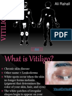 Vitiligo