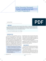 Restoration of The Severely Decayed Tooth Using Crown Lengthening With Simultaneous Tooth-Preparation