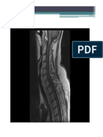 Transverse Myelitis