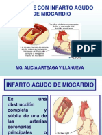 Infarto Agudo de Miocardio