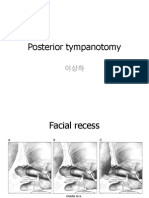 Posterior Tympanotomy