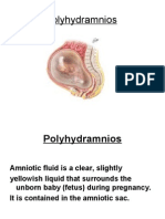 Over Distension of Uterus POLYHYDRAMNIOS