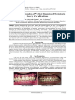 Prosthodontic Restoration of Vertical Dimension of Occlusion in Severly Worn Dentitions