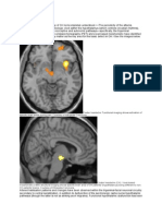 Pathophysiology of Cluster Headache