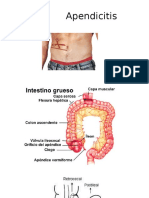 Apendicitis