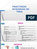 Fracturas Diafisiarias de Tibia