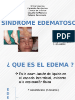 Sindrome Edematoso