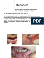 Iniciación Mucocele Ranula Sialolitiasis