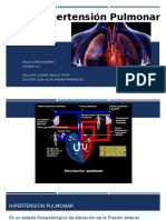 Hipertensión Pulmonar