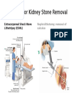 PhilHealth For Kidney Stone Removal