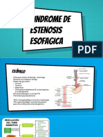 Estenosis Esofagica