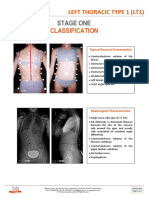 LT1 - Left Thoracic Type 1