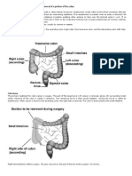 (Medicine) Surgical Removal of A Portion of The Colon.: Hemicolectomy-P1. Anastomoses