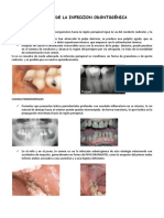 Clinica de La Infeccion Odontogénica