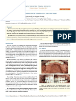 Bilateral Maxillary Buccal Bone Exostosis: Rare Case Report