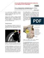 Caldwell Luc - Radical Antrostomy - Procedure Canine Fossa and Inferior Meatal Puncture and Inferior Meatal Antrostomy