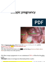 Ectopic Pregnancy Important