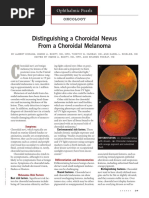 Distinguishing A Choroidal Nevus From A Choroidal Melanoma PDF