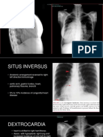 Dextrocardia