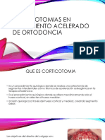 Corticotomias en Tratamiento Acelerado de Ortodoncia