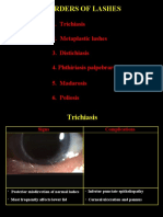 Disorders of Eye Lashes