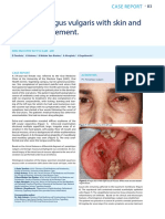 Pemphigus Vulgaris