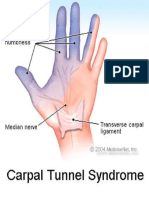 Sindrom Tunel Carpian - STC