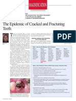 The Epidemic of Cracked and Fractured Teeth