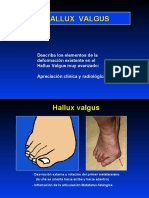 Hallux Valgus