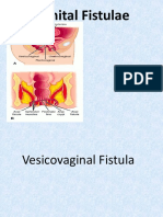 Fistula Genitalia