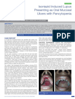 Isoniazid Induced Lupus Presenting As Oral Mucosal Ulcers With Pancytopenia