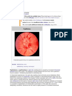 Papilledema: Jump To Navigationjump To Search