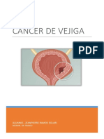 Cáncer de Vejiga