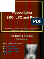 Recognizing SBO, LBO and Ileus