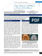 Double Banded Space Regainer (DBSR) in Distalising Two Teeth - A Case Report